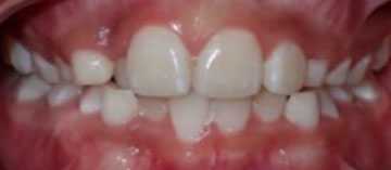 Teath Before