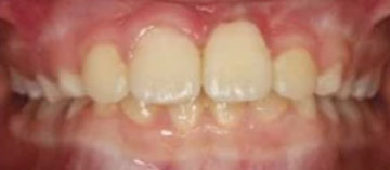 Teath After