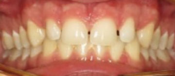 Teath Before