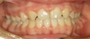 Teath After