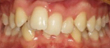 Teath Before
