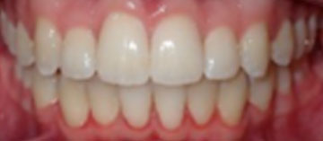 Teath After