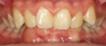 Teath Before