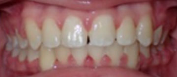 Teath After