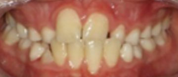 Teath Before