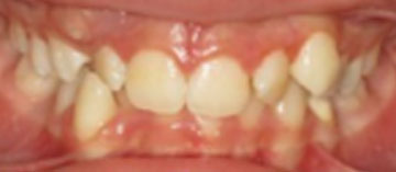 Teath Before