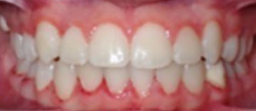 Teath After