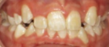 Teath Before