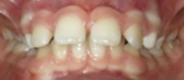 Teath Before