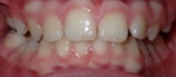 Teath After