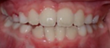 Teath After