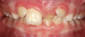 Teath Before