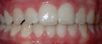 Teath After