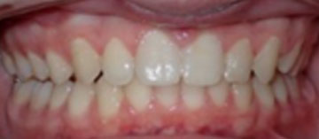 Teath After