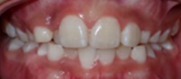 Teath Before