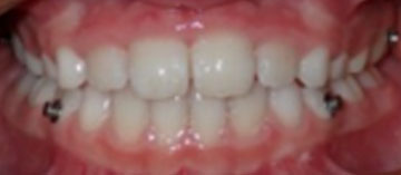 Teath After