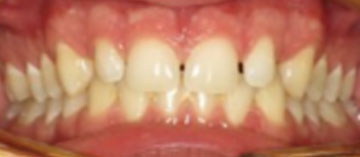 Teath Before