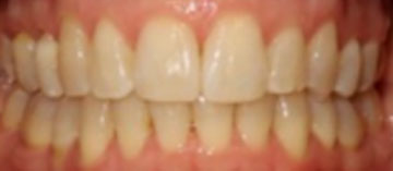 Teath After